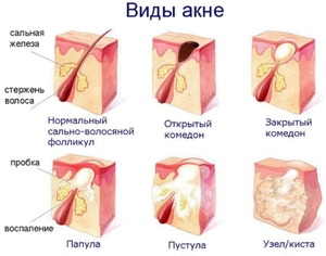 Виды заболевания акне Заболевание акне