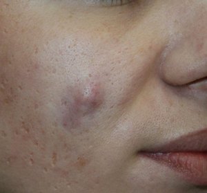 Воспаленная атерома щеки - внешний вид образования. Воспаленная атерома вздувается и меняет цвет.