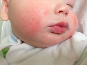Крапивница на лице Как выглядит крапивница на лице